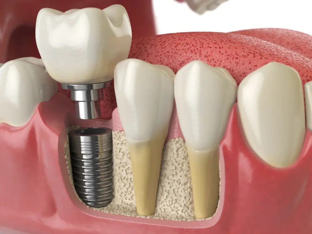A Detailed Evaluation Of Dental Implants